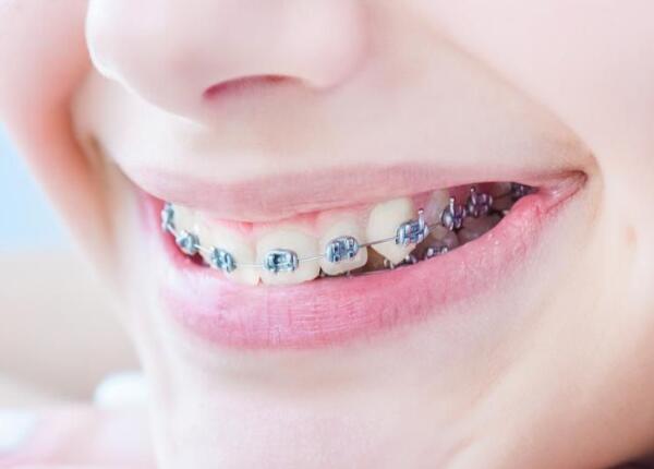 戴了牙套可以用電動牙刷嗎？戴牙套的人群必看！