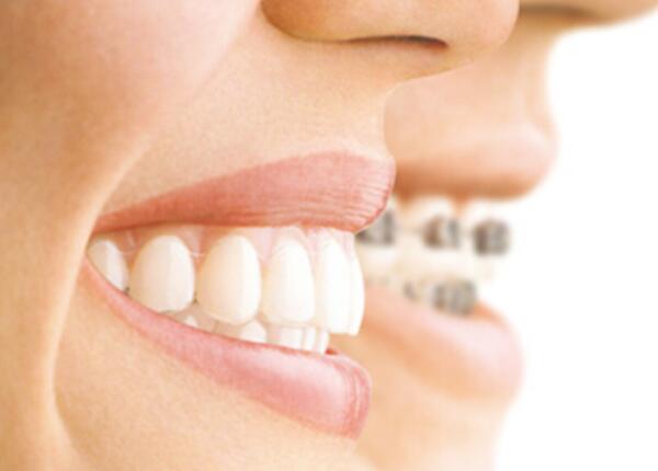 牙齒矯正者 成人聲波電動牙刷使用注意事項