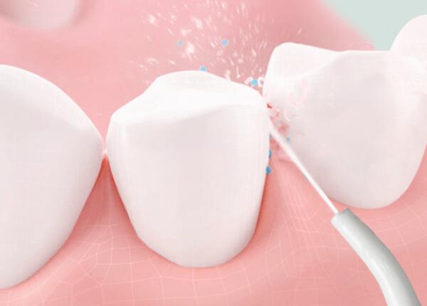 洗牙后用洗牙器好還是電動牙刷？口腔清潔工具這樣選！